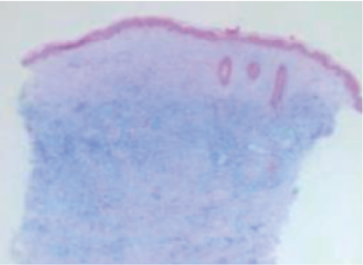 注射保柔緹後切片示意圖